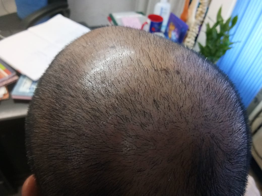 Cupping (Hijama) Treatment For Hair Loss